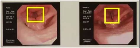 声带闭合图 声带闭合 声带图片图 大山谷图库