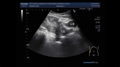 Renal Angiomyolipoma Youtube