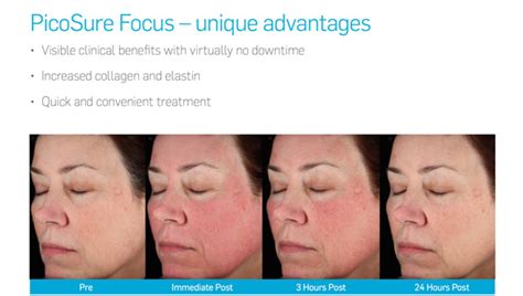 Picosure Focus Aka Picoskin Rejuvenation Treatment By Nyc Picosure