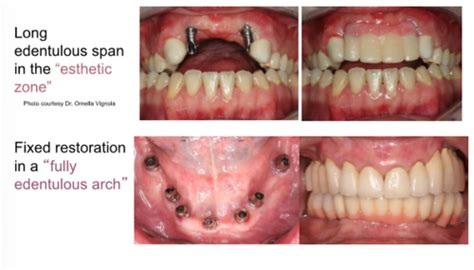 2 Implant Supported Prosthesis Flashcards Quizlet