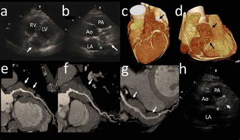 Figure Transthoracic Echocardiography And Computed Tomography Ct Of