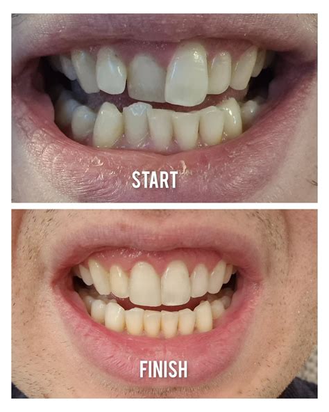 20 Trays 9 Refinements Final Result 🥳 R Invisalign