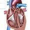 Hemodialysis Catheter Arrow Clark Vectorflow Truphatek