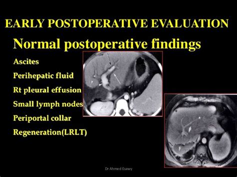 Imaging Liver Transplantation Post Operative Dr Ahmed Esawy