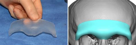 Custom Facial Implants Ix Brow Ridge Enhancement Explore Plastic