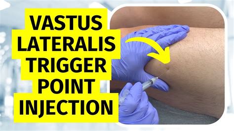 Trigger Point Injection Vastus Lateralis Technique Youtube