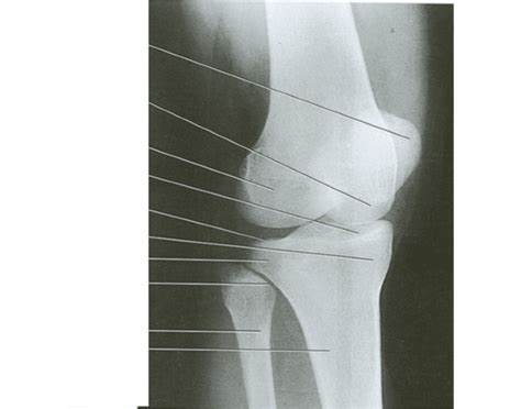 Medial Oblique Knee Quiz