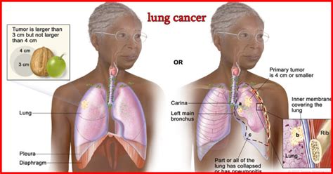 Non Small Cell Lung Cancer Icd 10 The Ultimate Guide For 2024