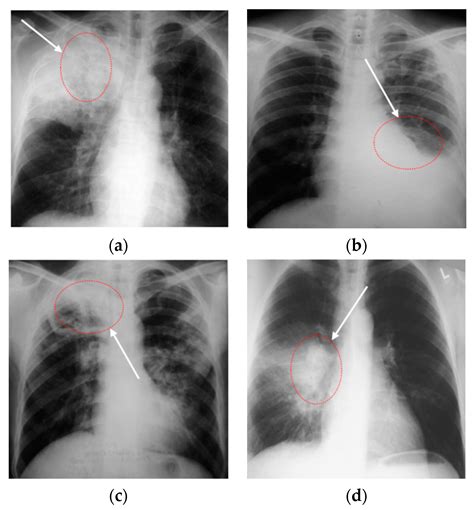 Tuberculosis Lung X Ray