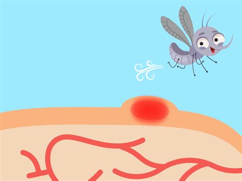 Why Do Mosquito Bites Itch Here Is The Science Behind It