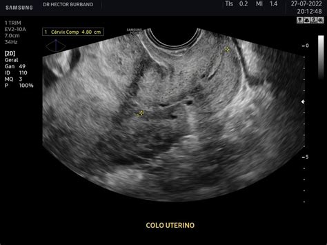 Avalia O Transvaginal Do Comprimento Do Colo Uterino Medfem