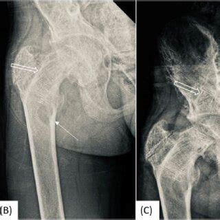 AP X Ray Of The Bilateral Knee And The Right Proximal Femur Of The Same