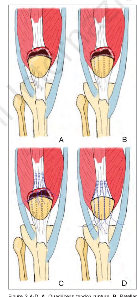 Quadriceps Muscle Tear