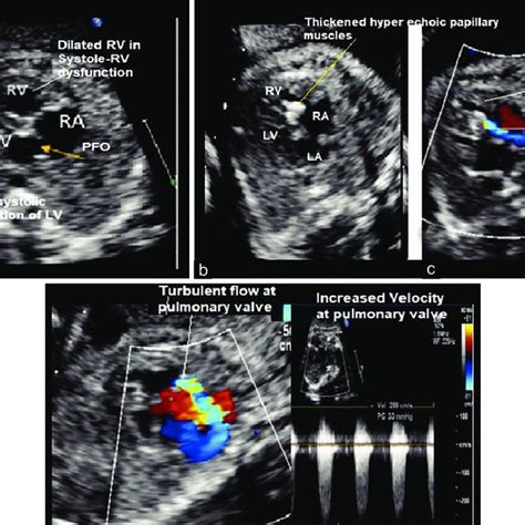 Critical Pulmonary Stenosis In At 32 Weeks Of Gestation A