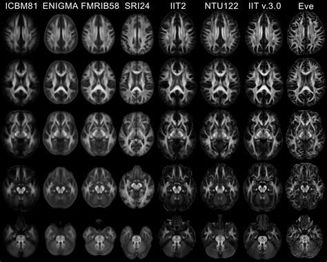 MRIIT - DTI template comparison