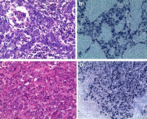 Epsteinbarr Virus Associated Intrahepatic Cholangiocarcinoma Bearing