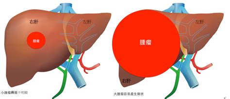 認識肝癌 癌症資訊網