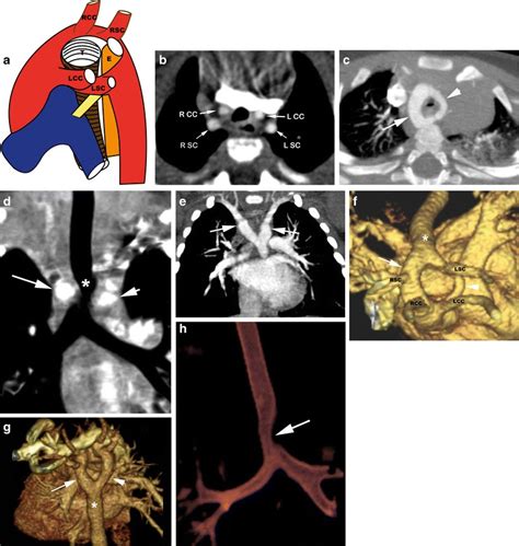 double aortic arch  illustration showing  appearances   double