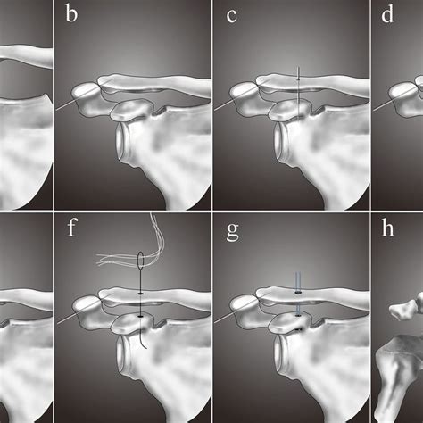 Pdf Comparison Of The Tightrope System Versus Hook Plate In Acute Acromioclavicular Joint