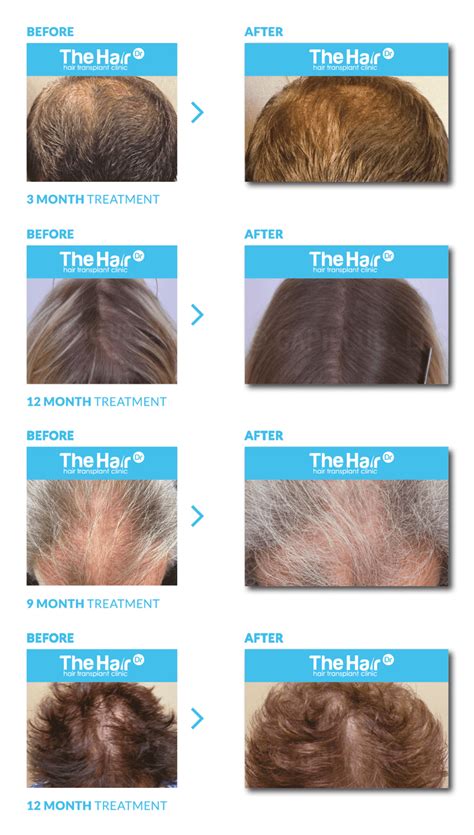 Low Level Laser Therapy For Hair Loss The Hair Dr