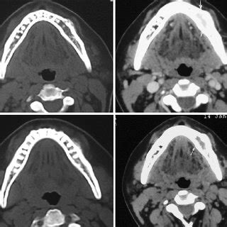 Opg View Shows Well Defi Ned Mixed Radiopaque Radiolucent Lesion With