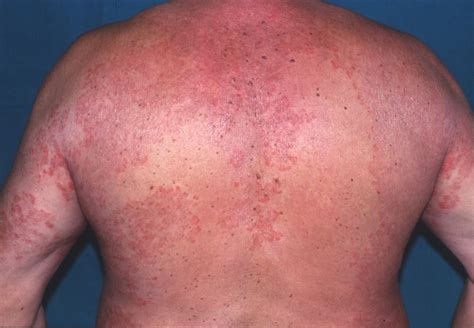 Tinea Fungal Skin Infections