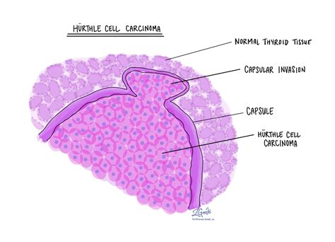 Hurthle cell adenoma | MyPathologyReport.ca