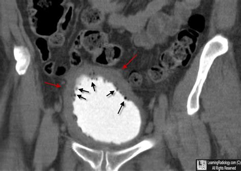 Learningradiology Emphysematous Cystitis Bladder Infection Gas