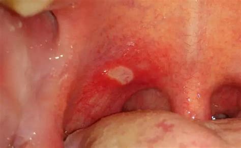 Red Spots On Back Of Throat And Roof Of Mouth Causes Otosection