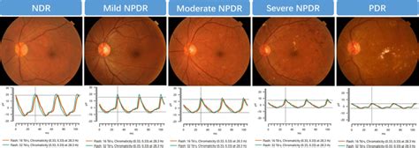 The representative fundus photographs and ERG waveforms of NDR, mild ...