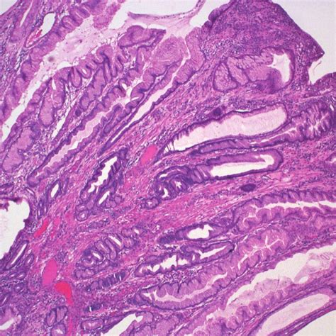 Medium Power Image Showing Gastric Hyperplastic Polyp On H E Staining