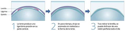 Ortoqueratología Encuentra los mejores profesionales en OrtoK