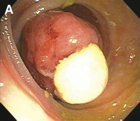 Rectal Bleeding Caused By A Large Partially Obstructing Lipoma Of The