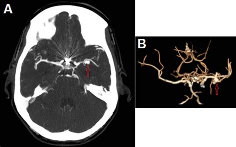 MCA aneurysm - DocNeuro