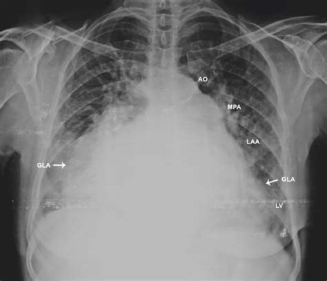 X Ray Chest PA Postero Anterior View Arrows Showing The Extension Of