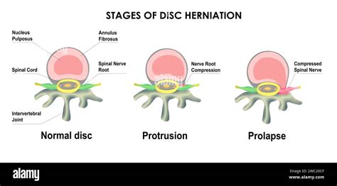 Difference Between Bulging Disc And Herniated Disc Stages Of Spinal