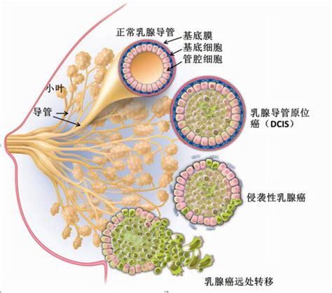 乳腺增生的五個階段，領略它的發展史 每日頭條