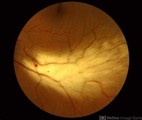 Myelinated Retinal Nerve Fibers Slide 2 Retina Image Bank