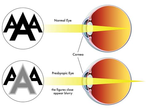 Presbyopia Johannesburg Eye Hospital