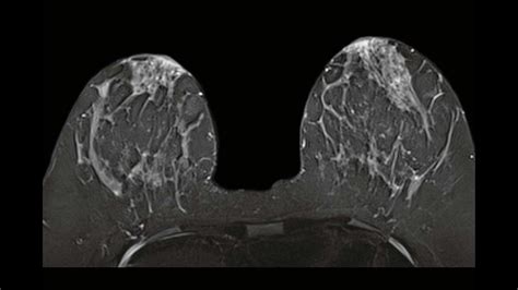 Breast MRI - Siemens Healthineers