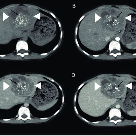 Axial Non Contrast Enhanced A Arterial Phase B Portal Phase C