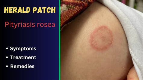 Herald Patch Pityriasis Rosea Causes Symptoms And Treatment Youtube