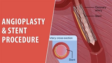 Angioplasty & Stent Procedure | Cardiac Rehab | Trusted Patient ...