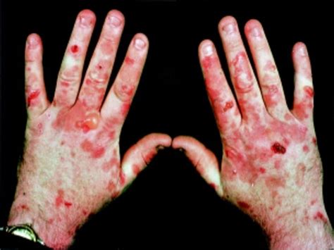 Porphyria