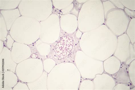 Lipoma Benign Growth Of Fatty Tissue Light Micrograph Photo Under