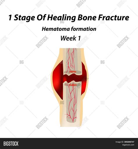 1 Stage Healing Bone Image & Photo (Free Trial) | Bigstock