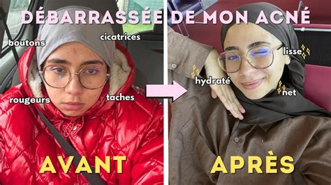 Comment Ne Plus Avoir D Acn Skincare Et Gua Sha Routines L A