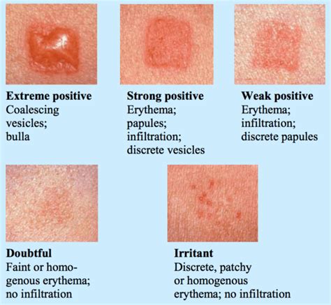 how to read allergy test results - pictures, photos