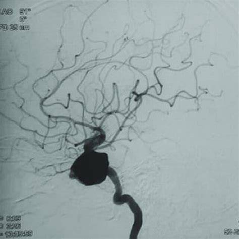 Lateral four vessel cerebral DSA showing a 40 Â 28 mm partially