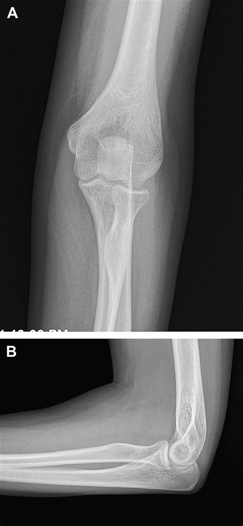 Valgus Extension Overload Diagnosis And Treatment Clinics In Sports Medicine